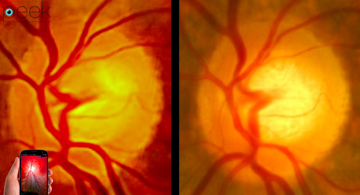 Confronto di un'immagine registrata da Peek Retina (sinistra) e uno con una telecamera oftalmologica dal costo stimabile in € 30.000 (destra).